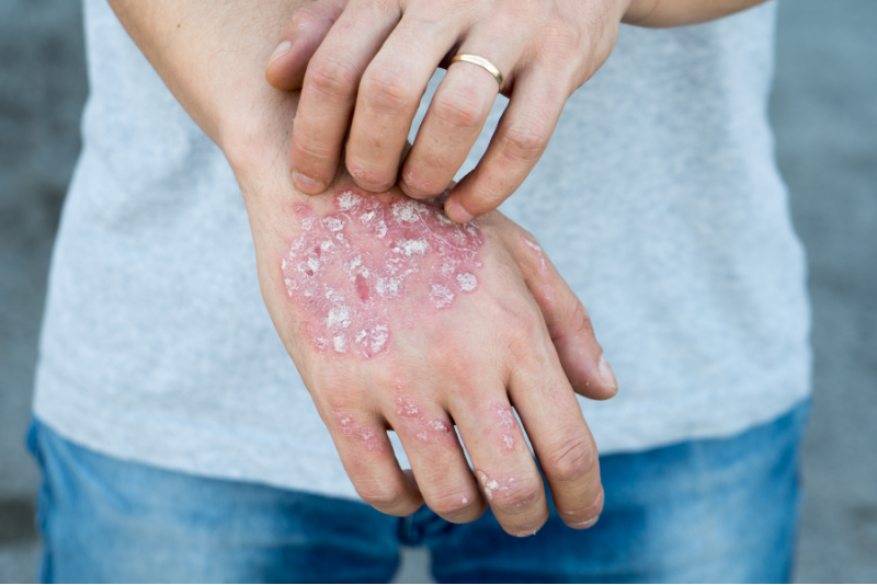 Systemic Corticosteroids Less Likely to Cause Severe Flares in Patients With a History of Psoriasis